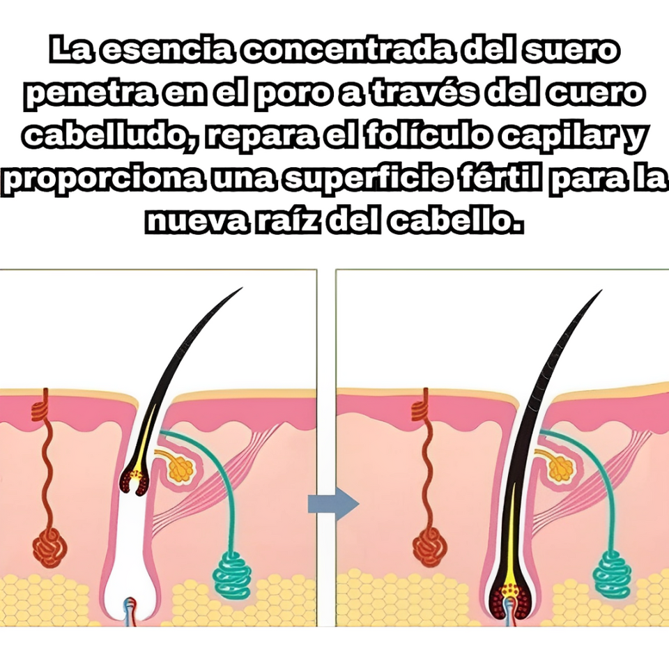 Suero capilar para combatir la calvicie con envío gratis, PAGA 2 & LLEVA 3💇‍♂️💖